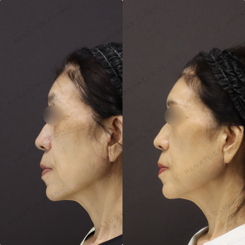 額ヒアルロン酸症例写真 額ヒアルロン酸症例写真