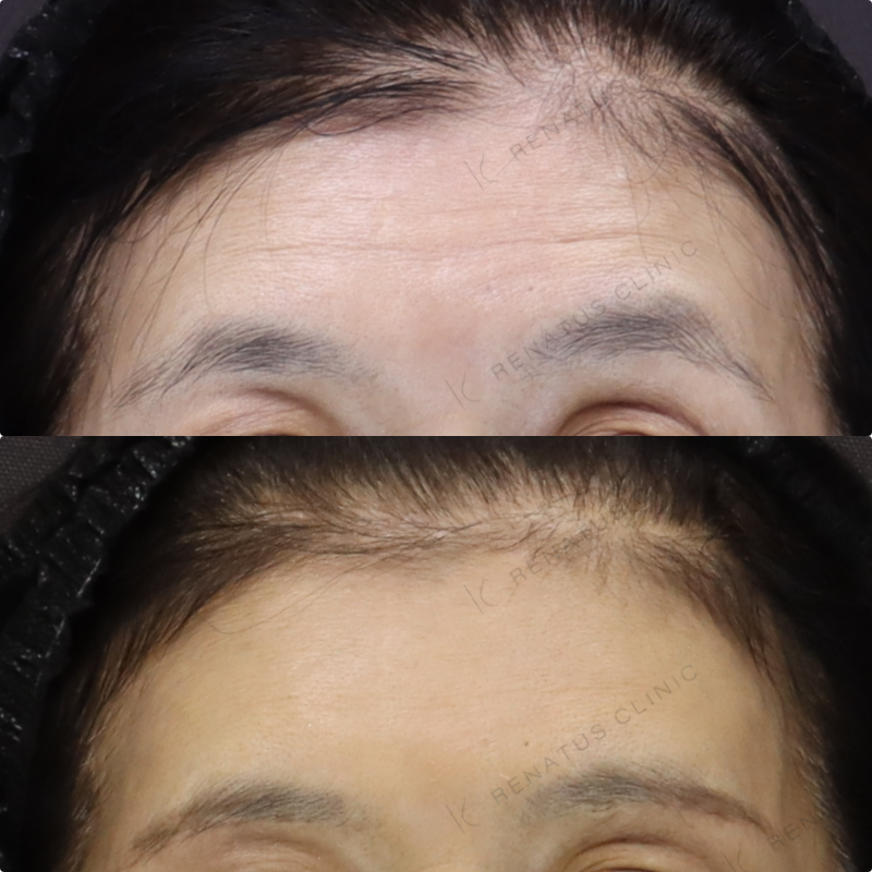 額ヒアルロン酸症例写真 額ヒアルロン酸症例写真