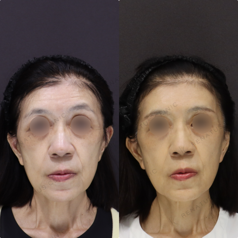 額ヒアルロン酸症例写真 額ヒアルロン酸症例写真