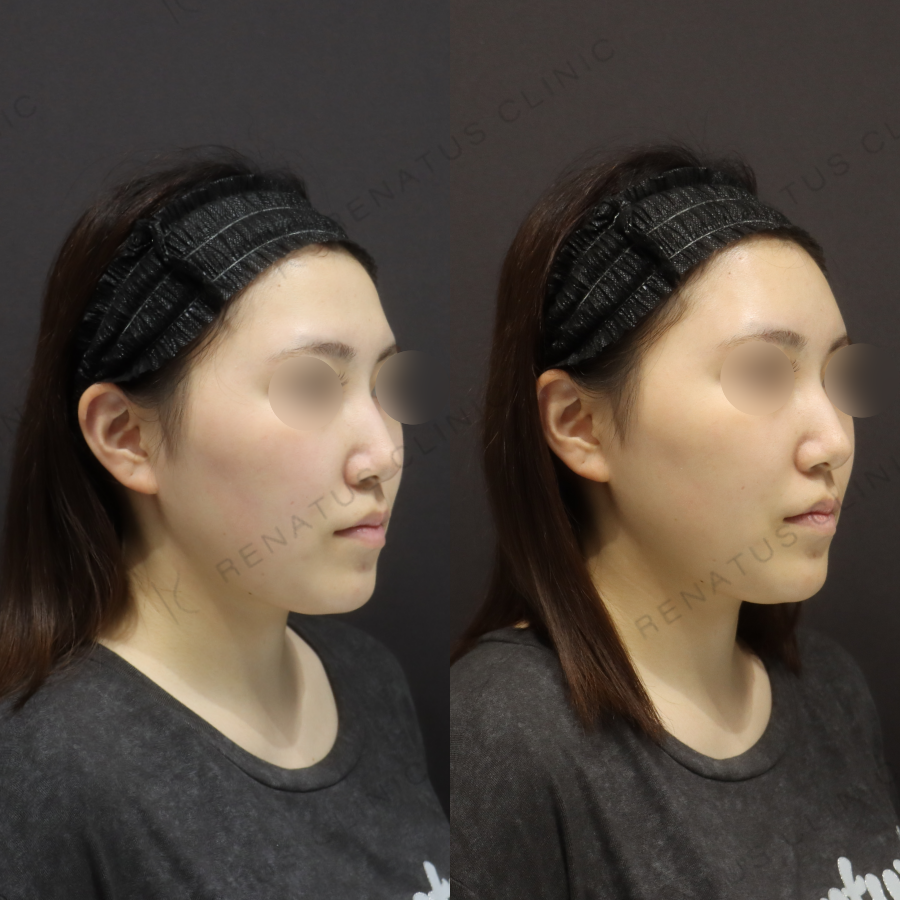 額ヒアルロン酸症例写真 額ヒアルロン酸症例写真