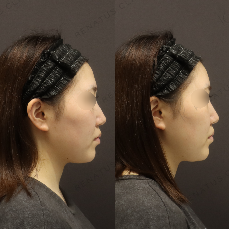 額ヒアルロン酸症例写真 額ヒアルロン酸症例写真