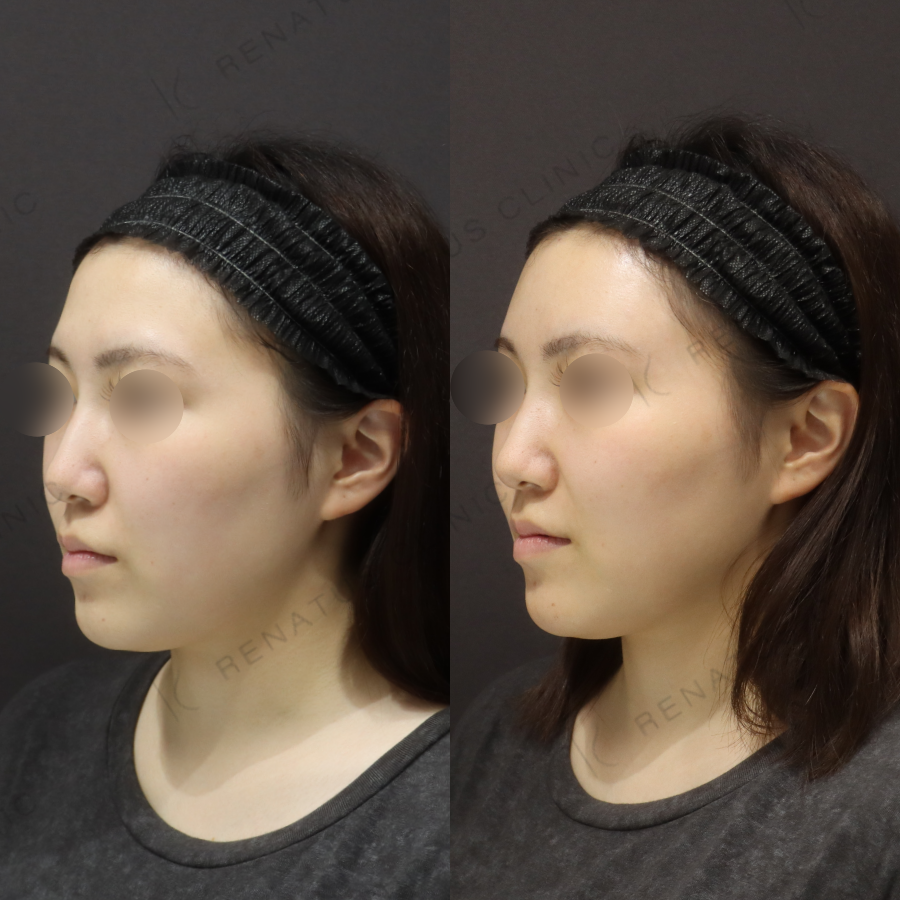 額ヒアルロン酸症例写真 額ヒアルロン酸症例写真