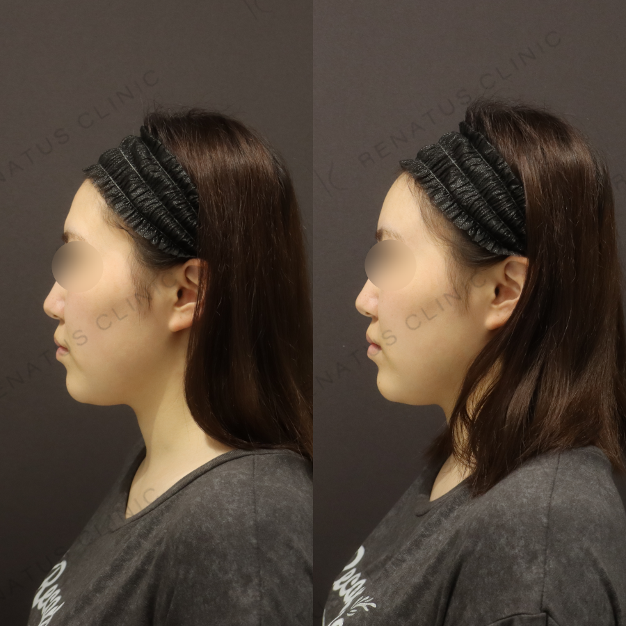 額ヒアルロン酸症例写真 額ヒアルロン酸症例写真