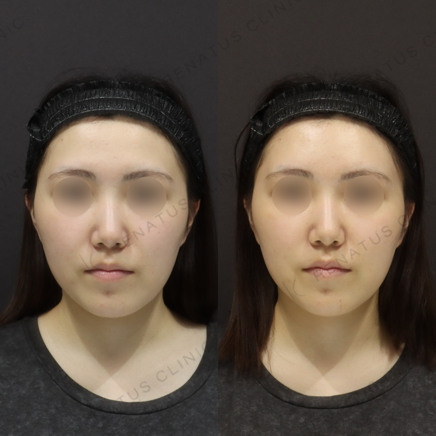 額ヒアルロン酸症例写真 額ヒアルロン酸症例写真