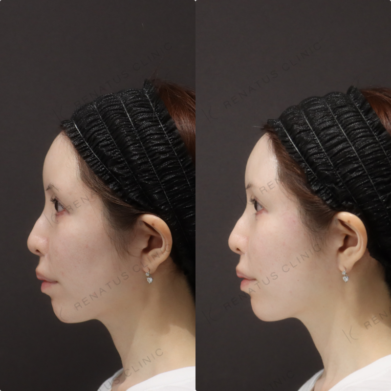 j額・こめかみヒアルロン酸症例写真 額・こめかみヒアルロン酸症例写真
