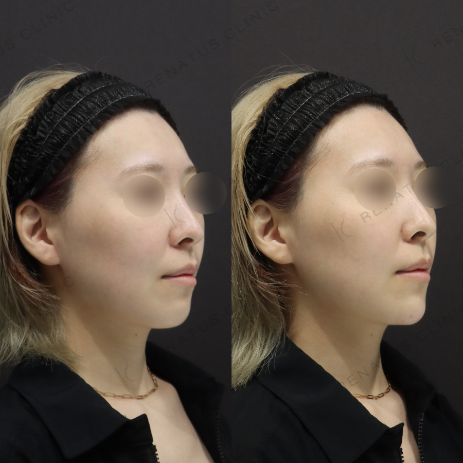 顎ヒアルロン酸症例写真 顎ヒアルロン酸症例写真