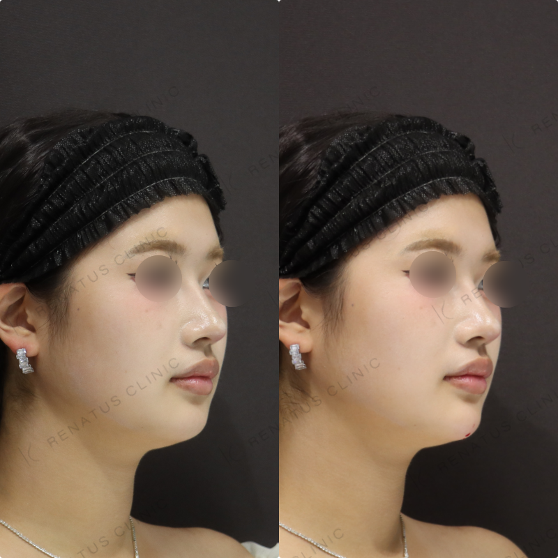 顎ヒアルロン酸症例写真 顎ヒアルロン酸症例写真