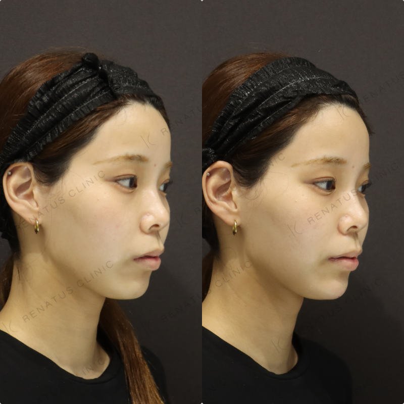 顎ヒアルロン酸症例写真 顎ヒアルロン酸症例写真