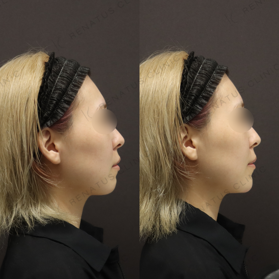 顎ヒアルロン酸症例写真 顎ヒアルロン酸症例写真