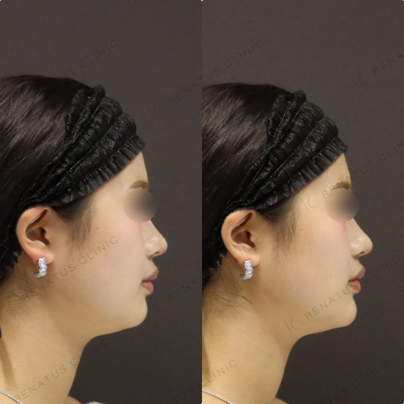 顎ヒアルロン酸症例写真