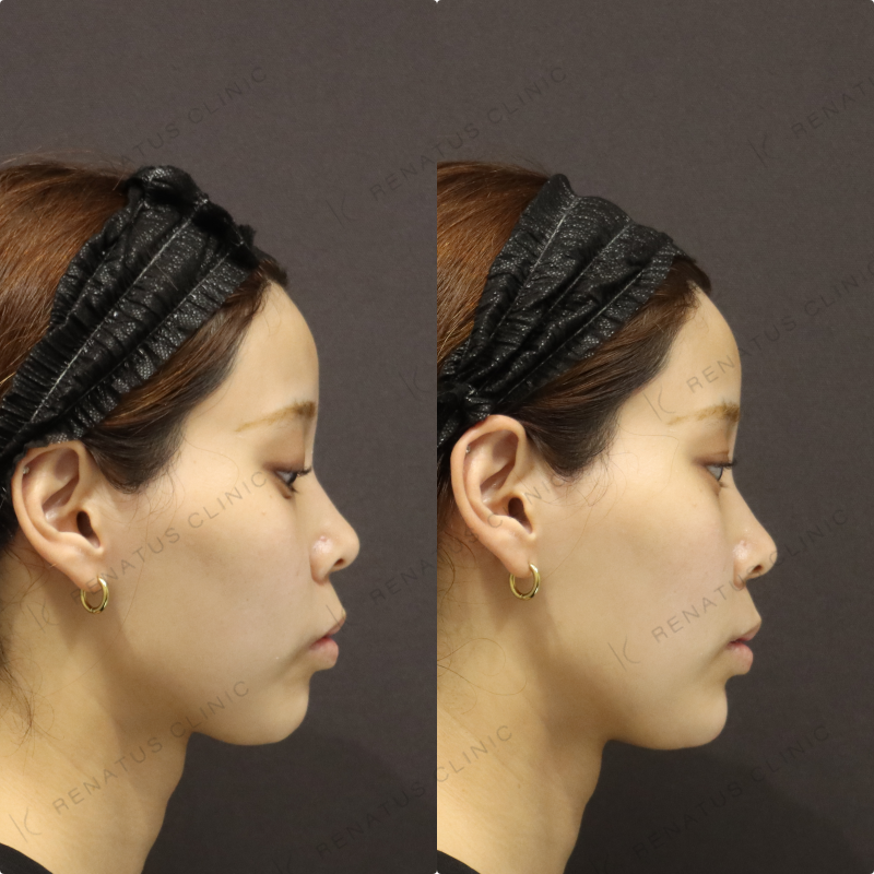 顎ヒアルロン酸症例写真 顎ヒアルロン酸症例写真