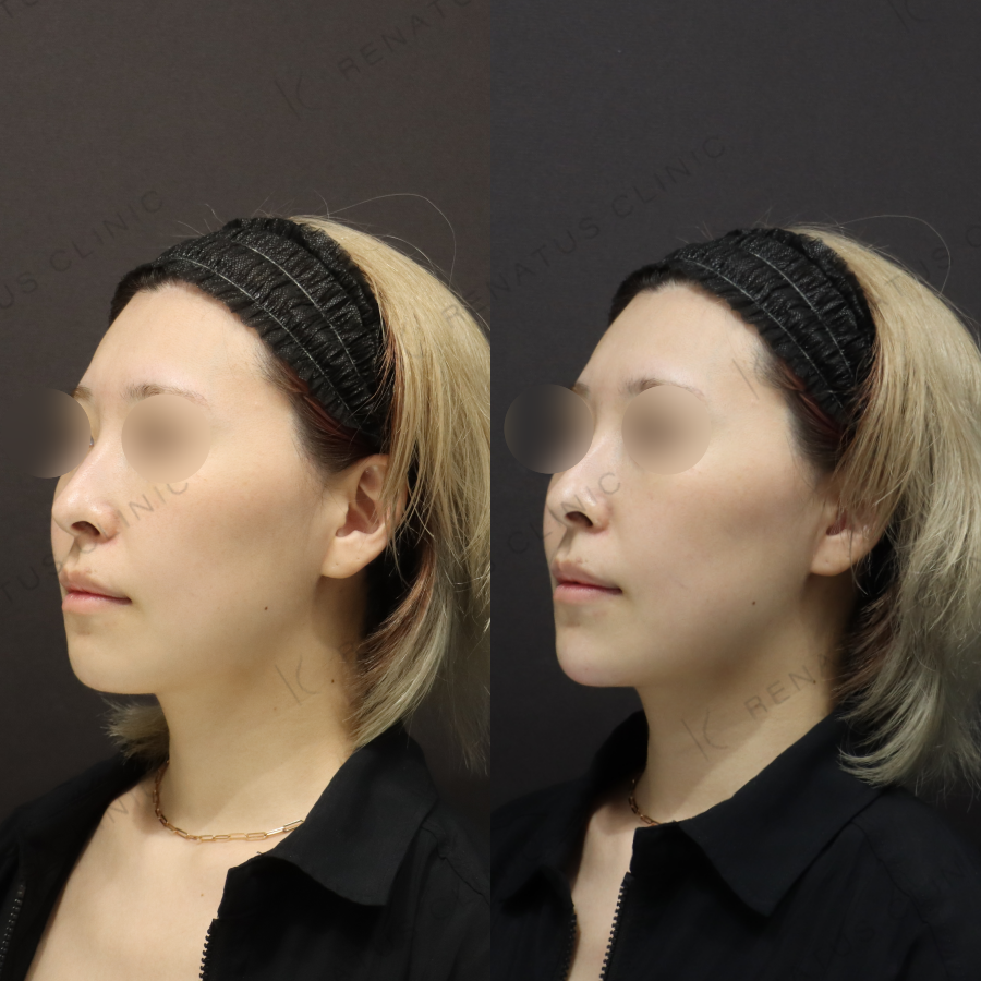 顎ヒアルロン酸症例写真 顎ヒアルロン酸症例写真