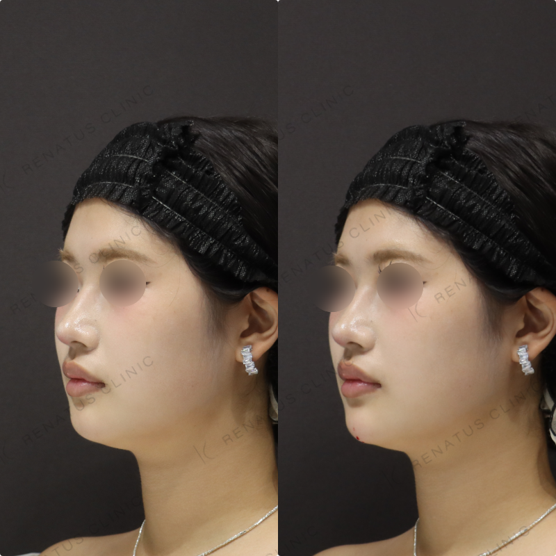 顎ヒアルロン酸症例写真 顎ヒアルロン酸症例写真