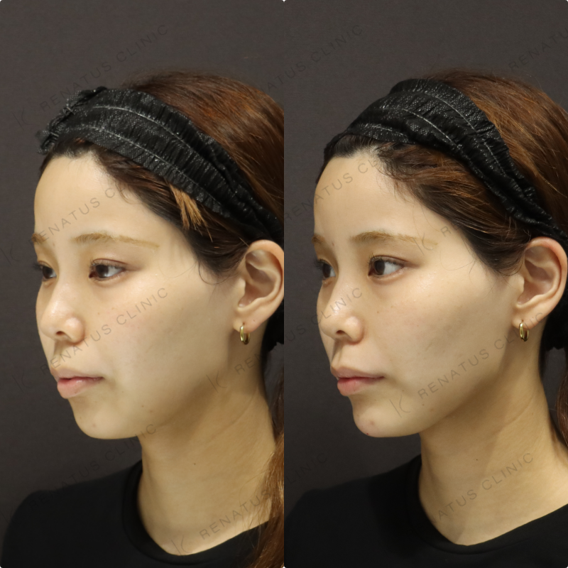 顎ヒアルロン酸症例写真 顎ヒアルロン酸症例写真