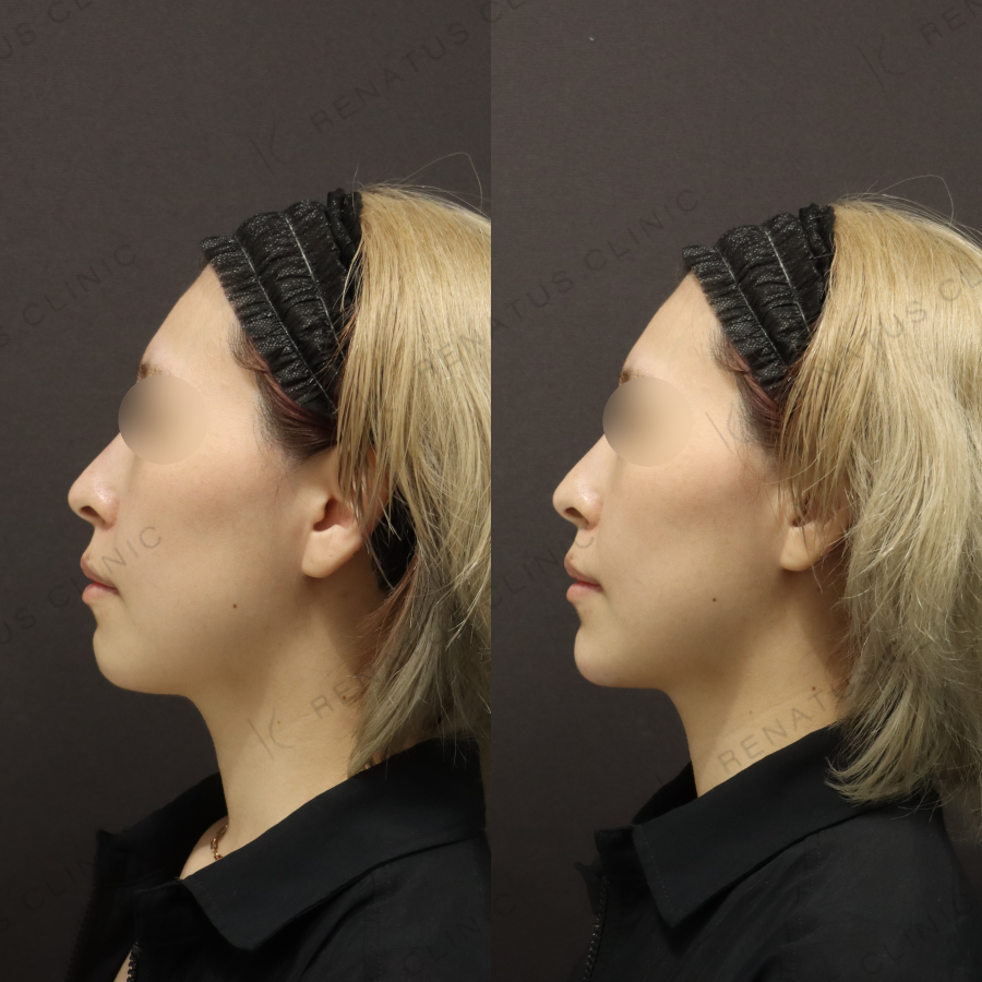 顎ヒアルロン酸症例写真 顎ヒアルロン酸症例写真