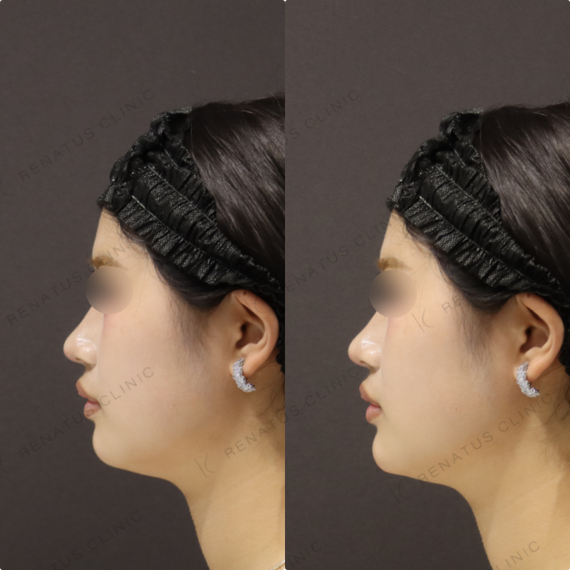 顎ヒアルロン酸症例写真 顎ヒアルロン酸症例写真