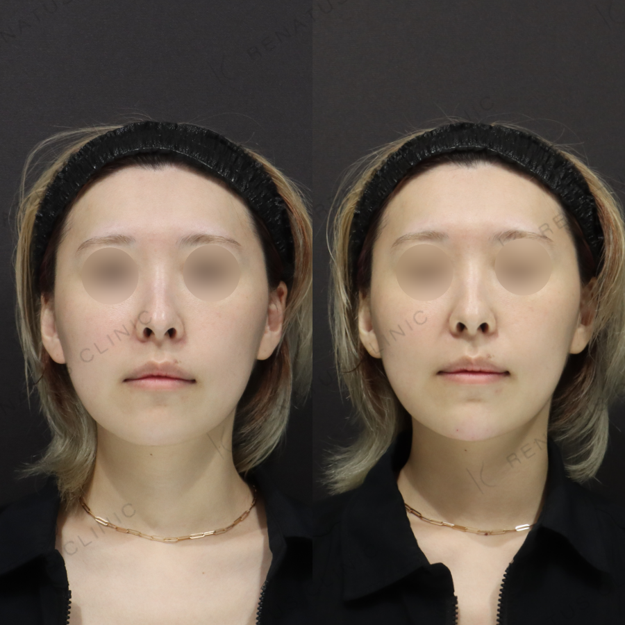 顎ヒアルロン酸症例写真 顎ヒアルロン酸症例写真
