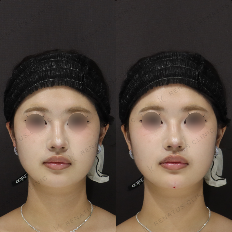 顎ヒアルロン酸症例写真 顎ヒアルロン酸症例写真