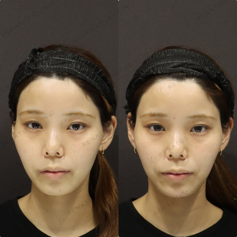 顎ヒアルロン酸症例写真 顎ヒアルロン酸症例写真