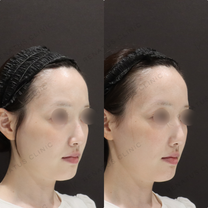 鼻翼基部ヒアルロン酸症例写真 鼻翼基部ヒアルロン酸症例写真