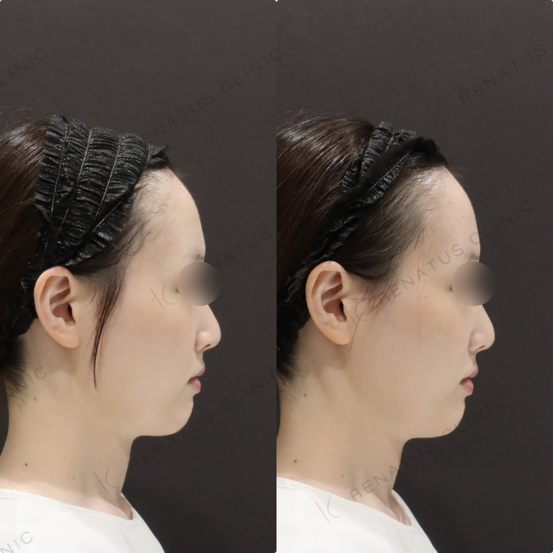 鼻翼基部ヒアルロン酸症例写真 鼻翼基部ヒアルロン酸症例写真