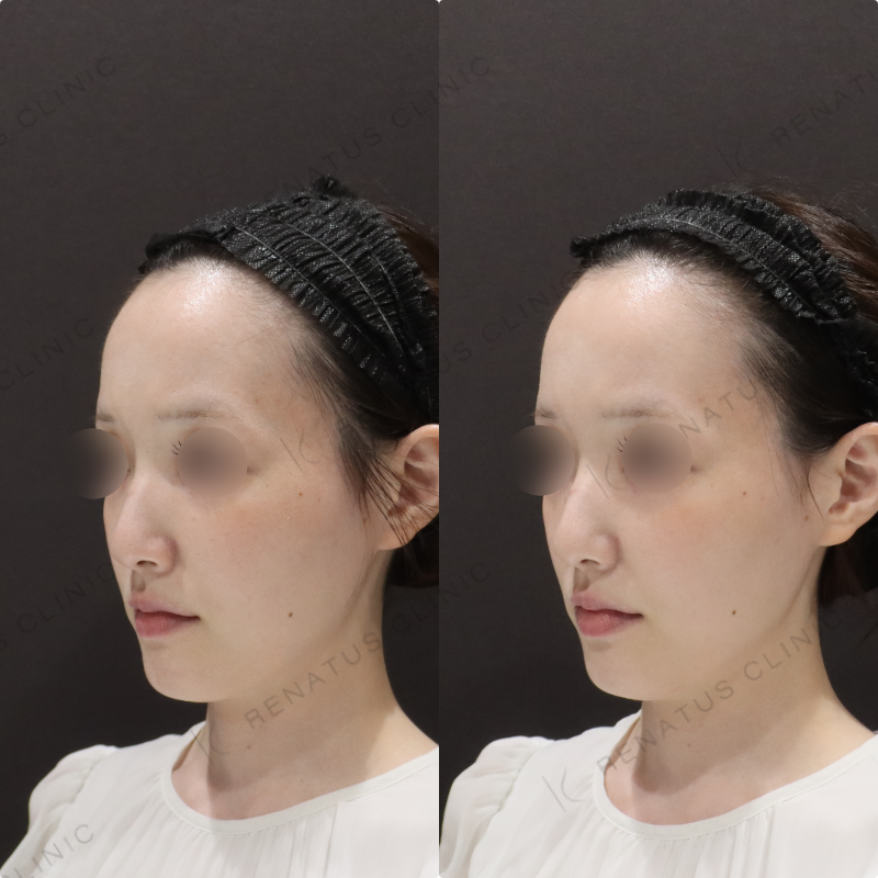 鼻翼基部ヒアルロン酸症例写真 鼻翼基部ヒアルロン酸症例写真