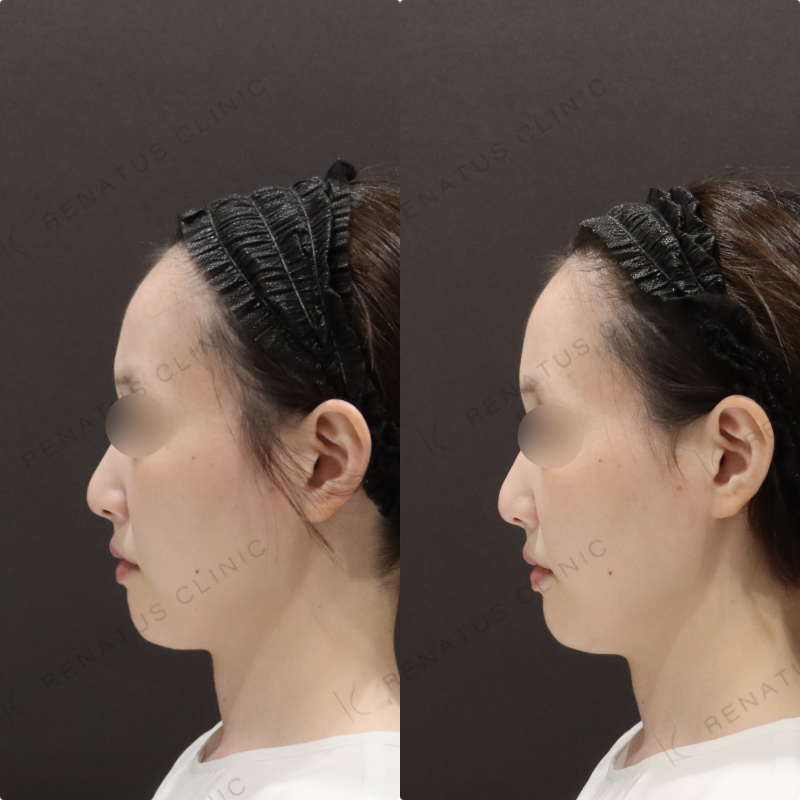 鼻翼基部ヒアルロン酸症例写真 鼻翼基部ヒアルロン酸症例写真