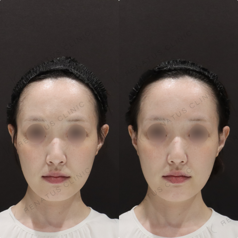 鼻翼基部ヒアルロン酸症例写真 鼻翼基部ヒアルロン酸症例写真