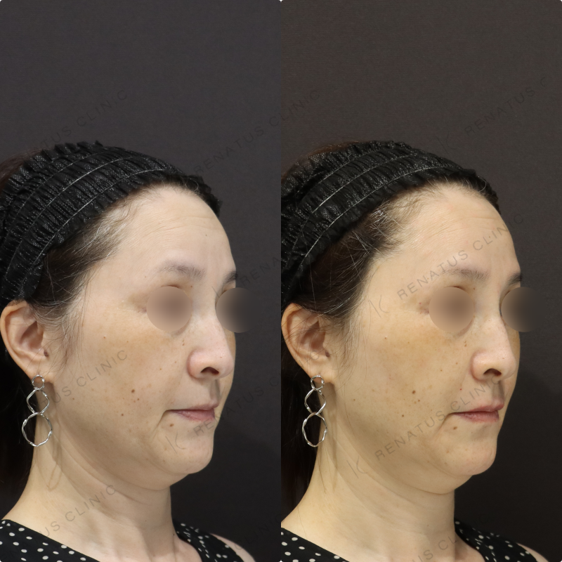 鼻翼基部・リフトアップヒアルロン酸症例写真 鼻翼基部・リフトアップヒアルロン酸症例写真