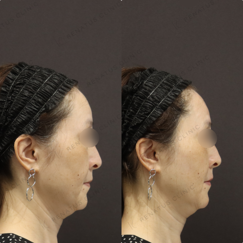 鼻翼基部・リフトアップヒアルロン酸症例写真 鼻翼基部・リフトアップヒアルロン酸症例写真