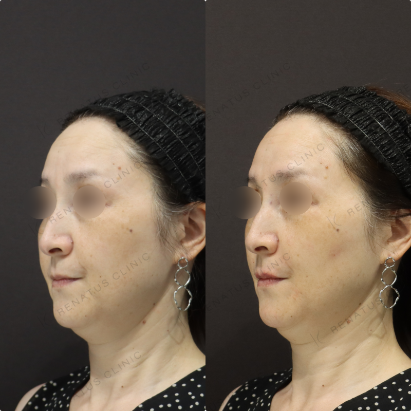 鼻翼基部・リフトアップヒアルロン酸症例写真 鼻翼基部・リフトアップヒアルロン酸症例写真