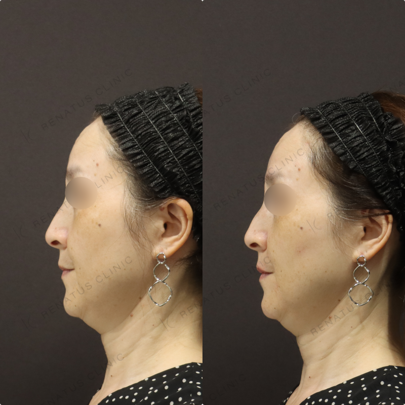 鼻翼基部・リフトアップヒアルロン酸症例写真 鼻翼基部・リフトアップヒアルロン酸症例写真