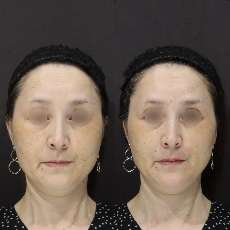 鼻翼基部・リフトアップヒアルロン酸症例写真 鼻翼基部・リフトアップヒアルロン酸症例写真