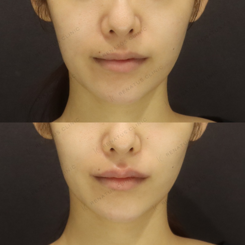 唇ヒアルロン酸ボルベラ症例写真 唇ヒアルロン酸ボルベラ症例写真