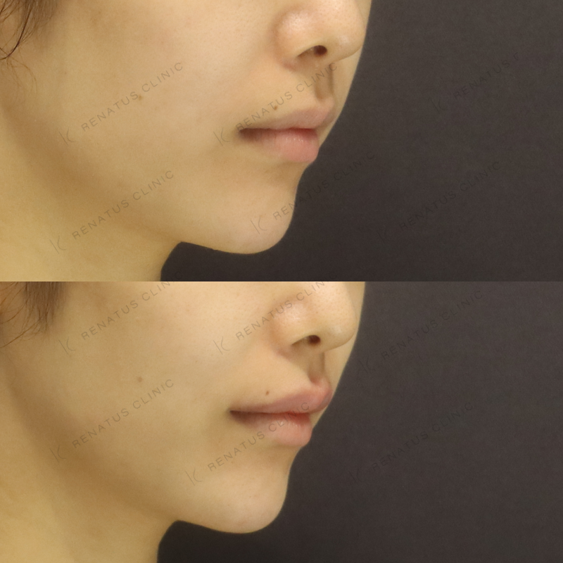 唇ヒアルロン酸ボルベラ症例写真 唇ヒアルロン酸ボルベラ症例写真