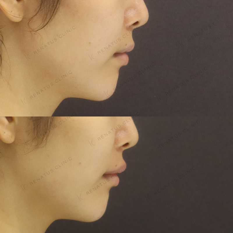 唇ヒアルロン酸ボルベラ症例写真 唇ヒアルロン酸ボルベラ症例写真