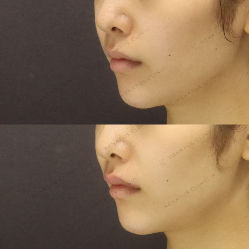 唇ヒアルロン酸ボルベラ症例写真 唇ヒアルロン酸ボルベラ症例写真