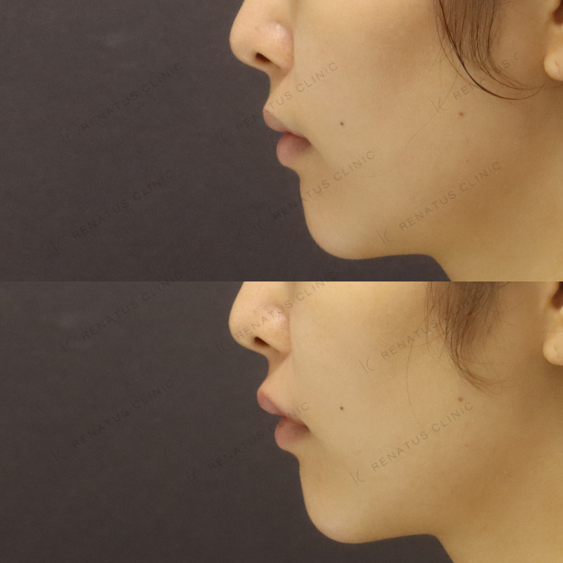 唇ヒアルロン酸ボルベラ症例写真 唇ヒアルロン酸ボルベラ症例写真