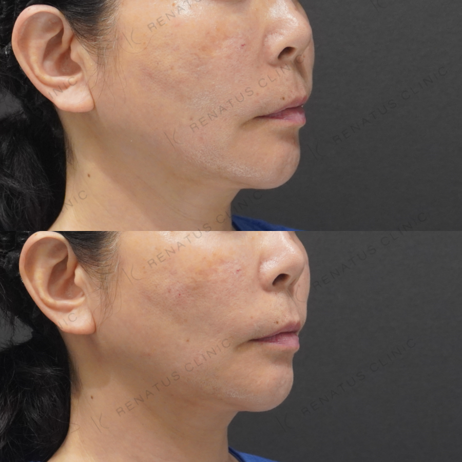 ゴルゴラインヒアルロン酸症例写真