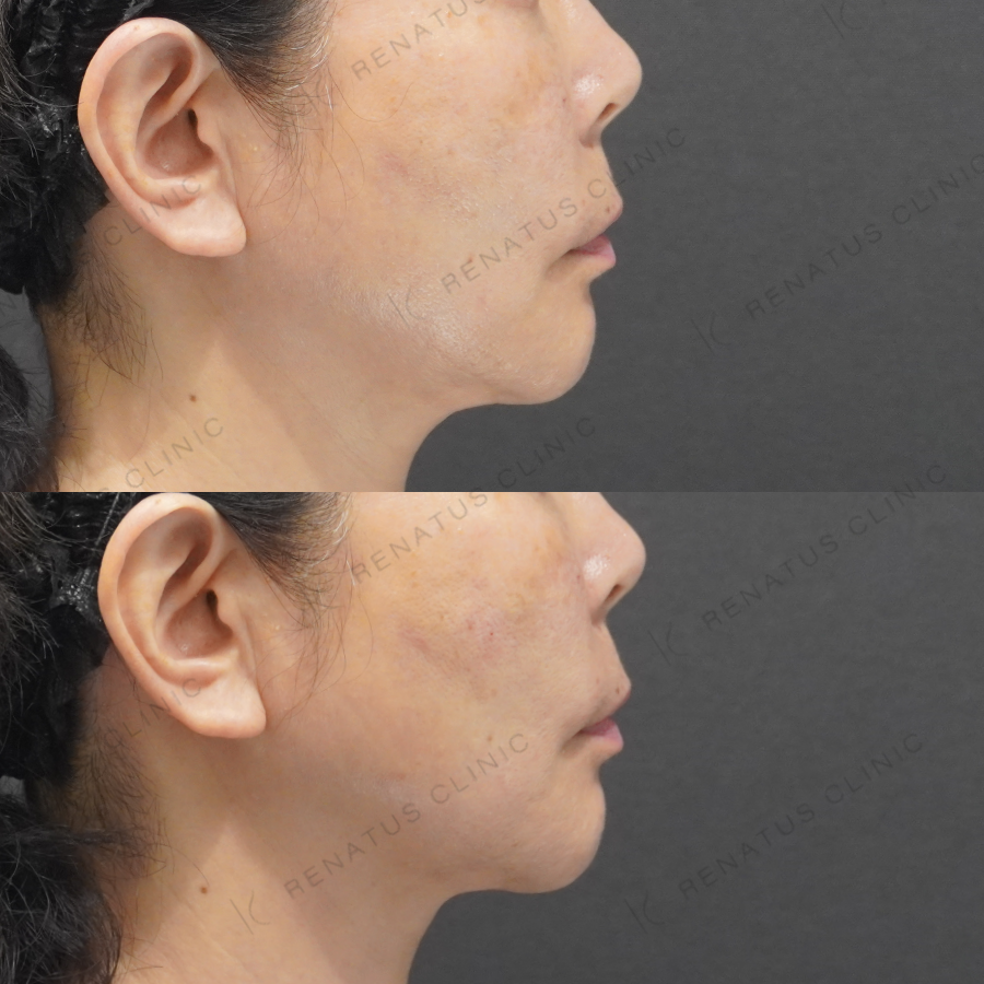 ゴルゴラインヒアルロン酸症例写真