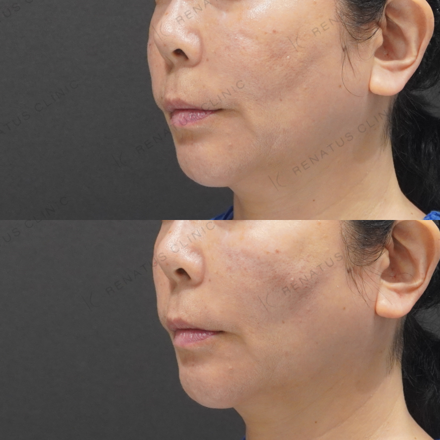 ゴルゴラインヒアルロン酸症例写真