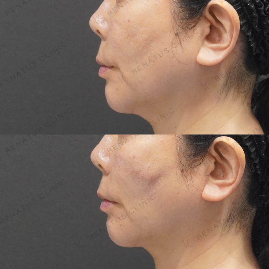 ゴルゴラインヒアルロン酸症例写真