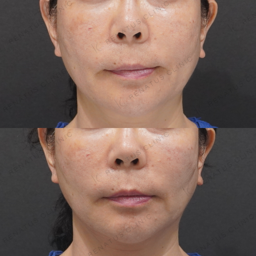 ゴルゴラインヒアルロン酸症例写真