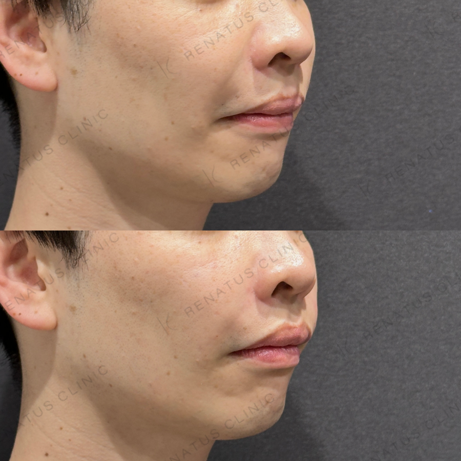 ゴルゴライン・ほうれい線ヒアルロン酸症例写真