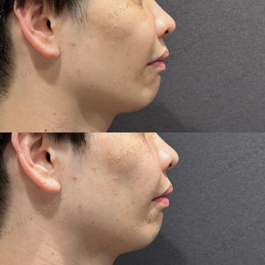 ゴルゴライン・ほうれい線ヒアルロン酸症例写真