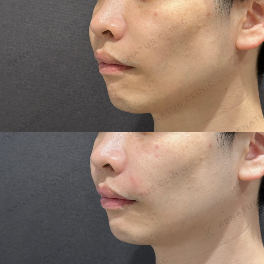 ゴルゴライン・ほうれい線ヒアルロン酸症例写真