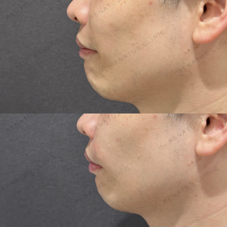 ゴルゴライン・ほうれい線ヒアルロン酸症例写真