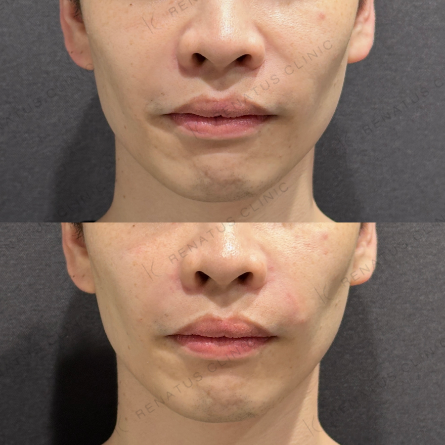 ゴルゴライン・ほうれい線ヒアルロン酸症例写真