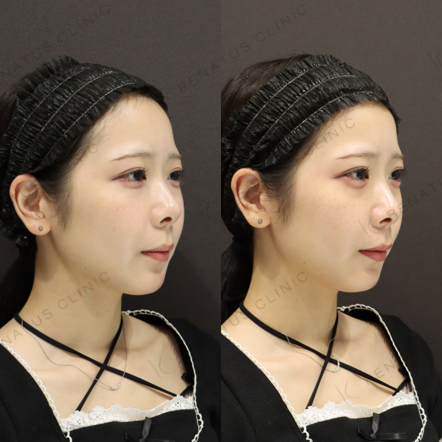 涙袋ヒアルロン酸症例写真