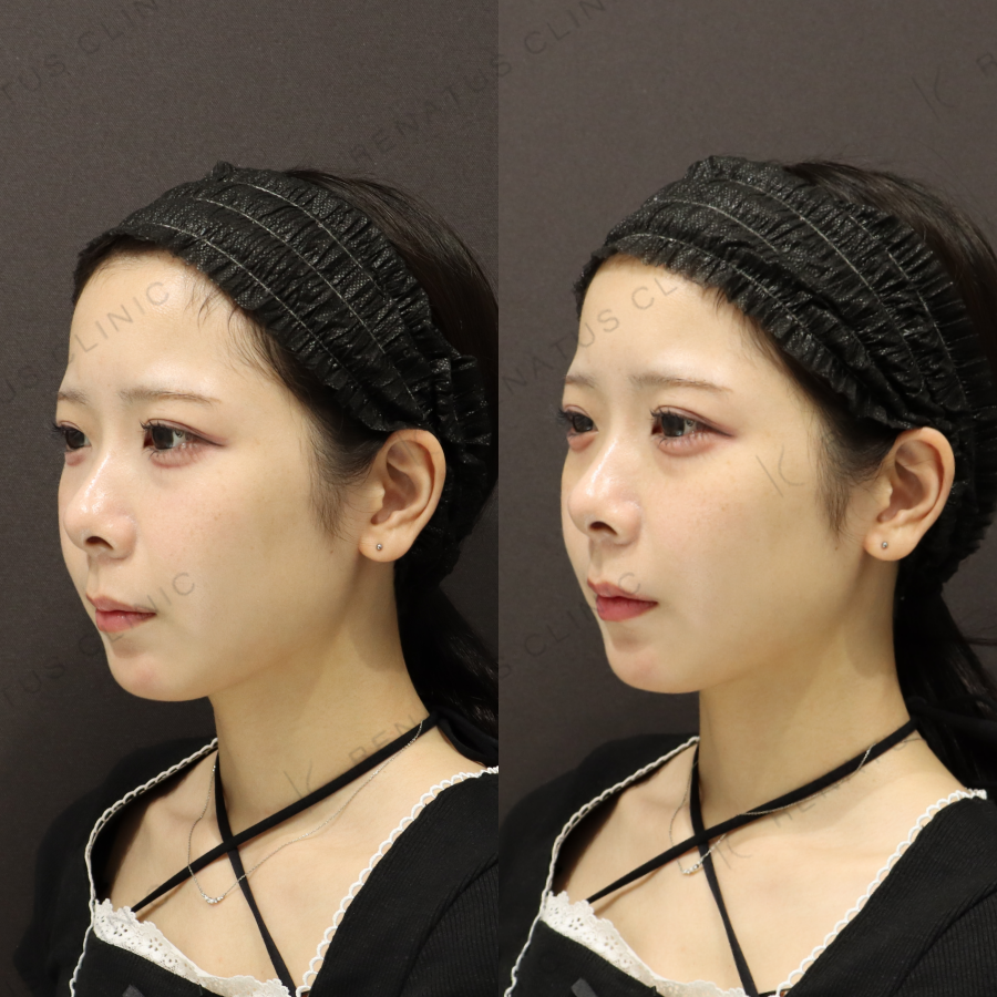 涙袋ヒアルロン酸症例写真
